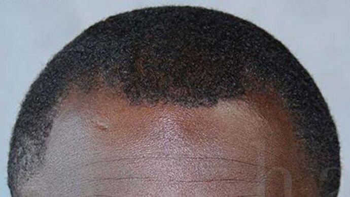 Ethnic Hair Restoration: Case 1 - Before