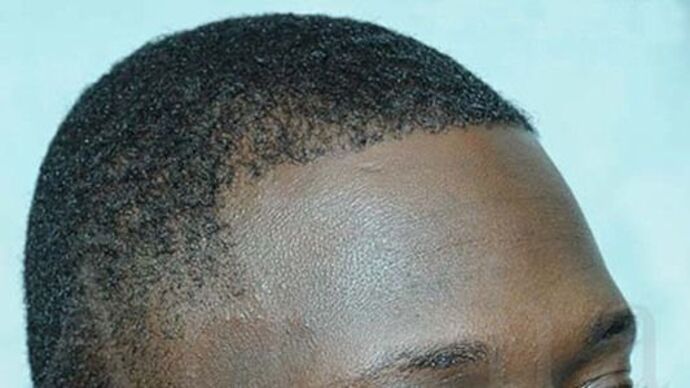 Ethnic Hair Restoration: Case 1 - After