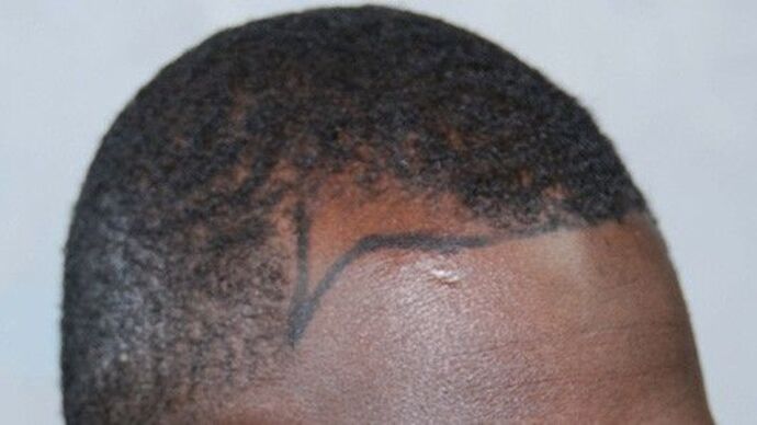 Ethnic Hair Restoration: Case 1 - Before