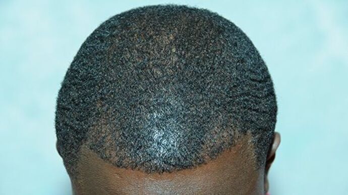 Ethnic Hair Restoration: Case 1 - After