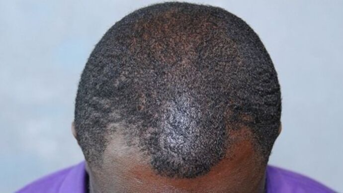 Ethnic Hair Restoration: Case 1 - Before