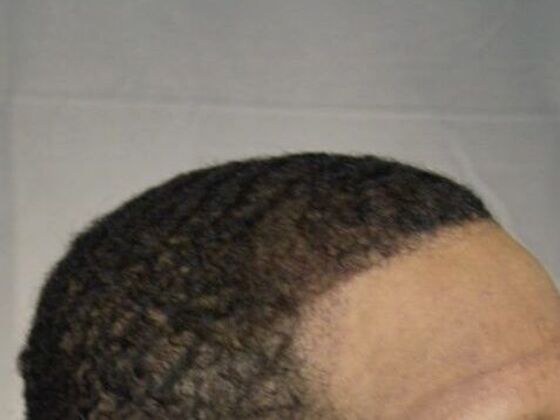 Ethnic Hair Restoration: Case 2 - After