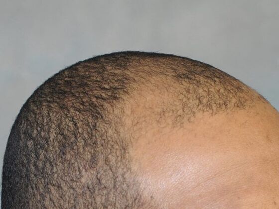 Ethnic Hair Restoration: Case 2 - Before