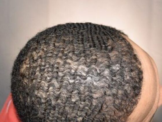 Ethnic Hair Restoration: Case 2 - After