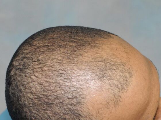 Ethnic Hair Restoration: Case 2 - Before