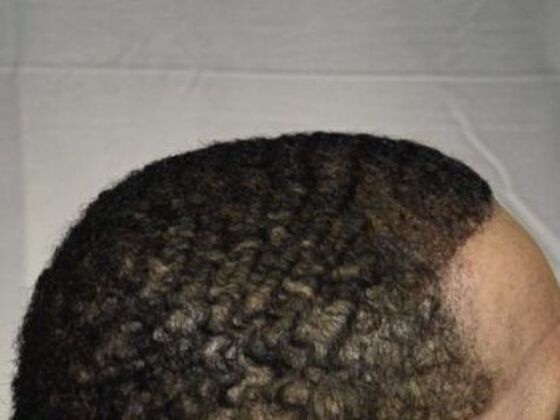 Ethnic Hair Restoration: Case 2 - After