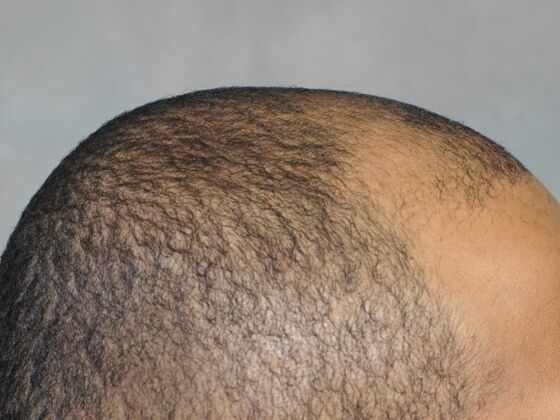 Ethnic Hair Restoration: Case 2 - Before