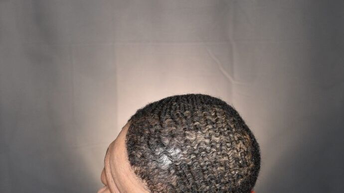 Ethnic Hair Restoration: Case 2 - After