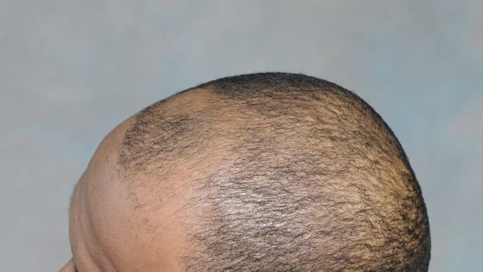 Ethnic Hair Restoration: Case 2 - Before