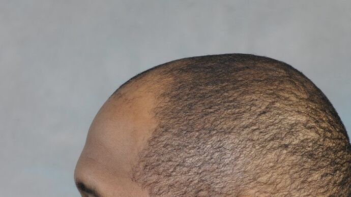 Ethnic Hair Restoration: Case 2 - Before