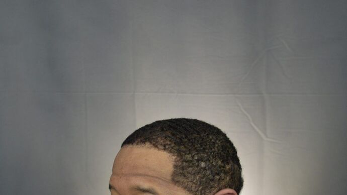 Ethnic Hair Restoration: Case 2 - After