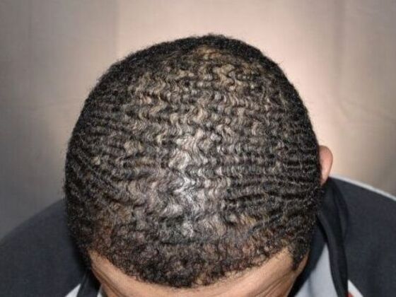 Ethnic Hair Restoration: Case 2 - After