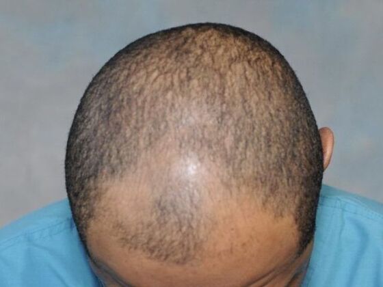 Ethnic Hair Restoration: Case 2 - Before