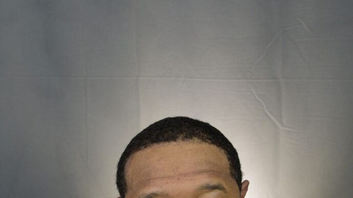 Ethnic Hair Restoration: Case 2 - After