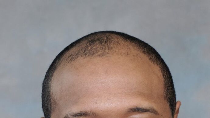 Ethnic Hair Restoration: Case 2 - Before