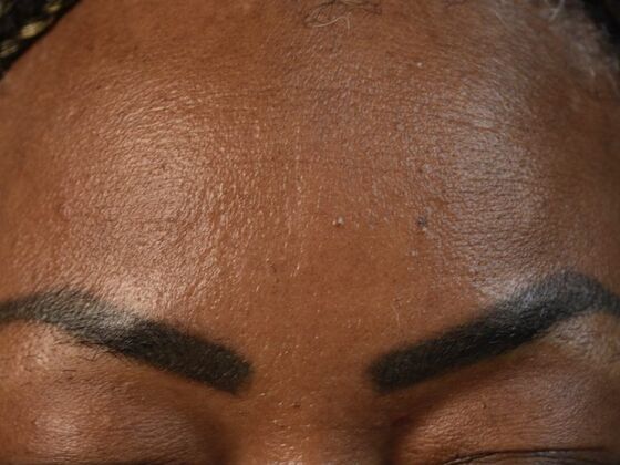 Facial Hair Transplantation: Case 1 - Before