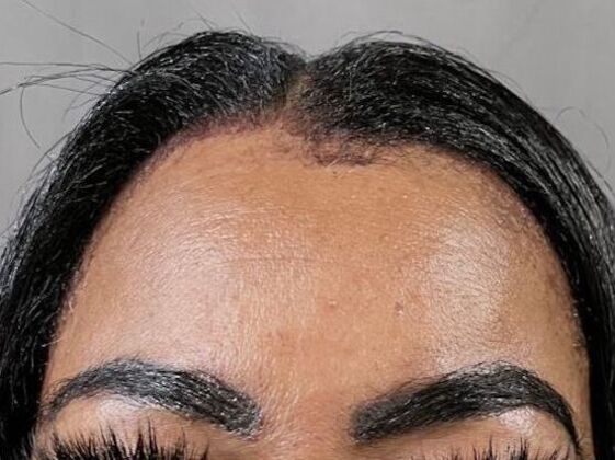 Facial Hair Transplantation: Case 1 - After