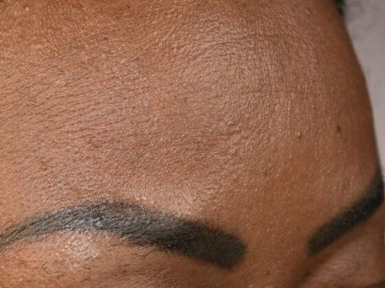 Facial Hair Transplantation Case 1 - Before