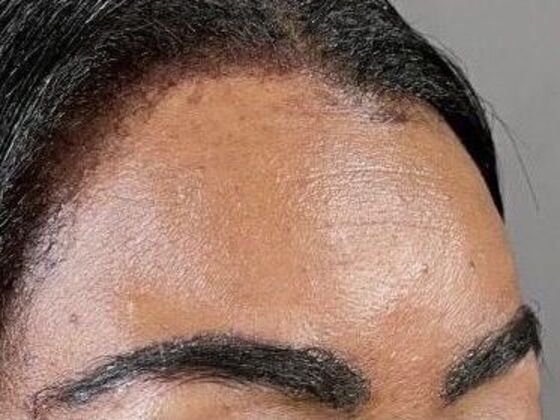 Facial Hair Transplantation Case 1 - After