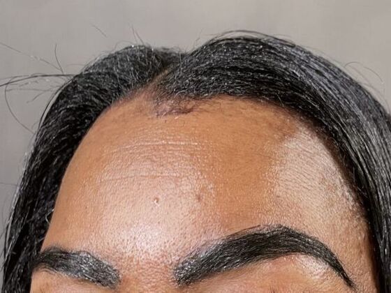 Facial Hair Transplantation: Case 1 - After