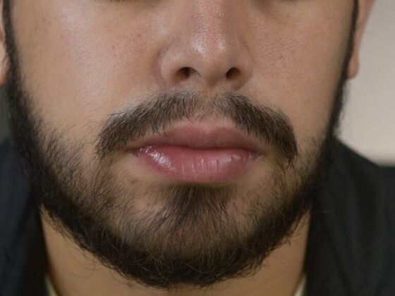 Facial Hair Transplantation: Case 2 - After