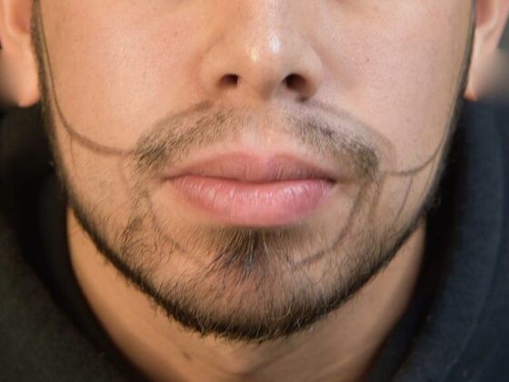 Facial Hair Transplantation: Case 2 - Before