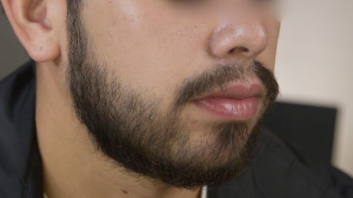 Facial Hair Transplantation: Case 2 - After