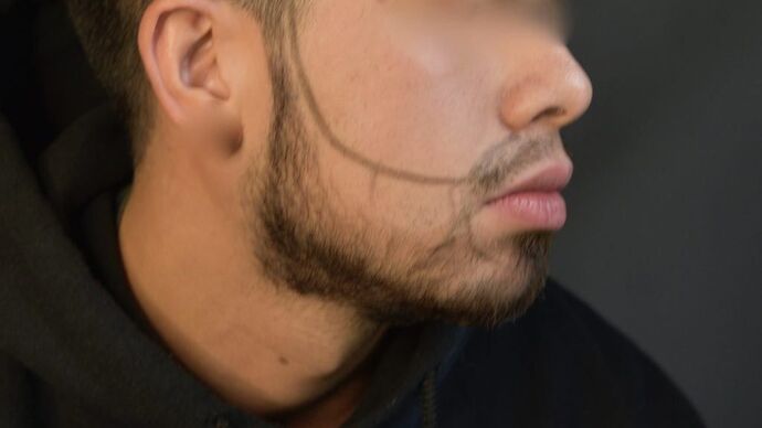 Facial Hair Transplantation: Case 2 - Before
