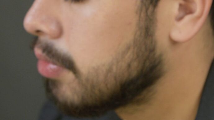 Facial Hair Transplantation: Case 2 - After