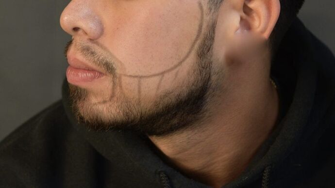 Facial Hair Transplantation: Case 2 - Before