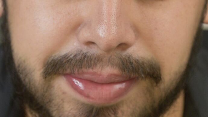 Facial Hair Transplantation: Case 2 - After