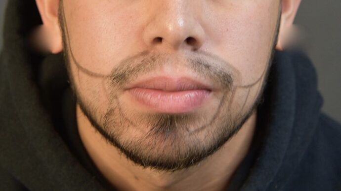 Facial Hair Transplantation: Case 2 - Before