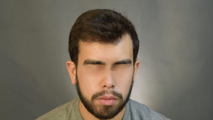 Facial Hair Transplantation: Case 2 - After