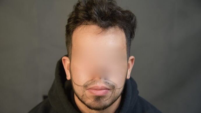 Facial Hair Transplantation: Case 2 - Before