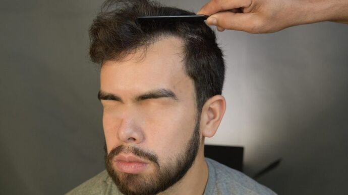 Facial Hair Transplantation: Case 2 - After