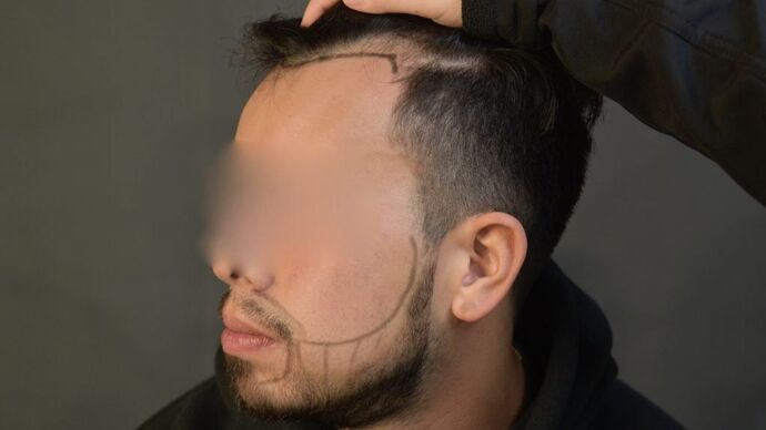 Facial Hair Transplantation: Case 2 - Before