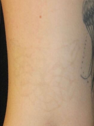 Laser Tattoo Removal Case 12 - After