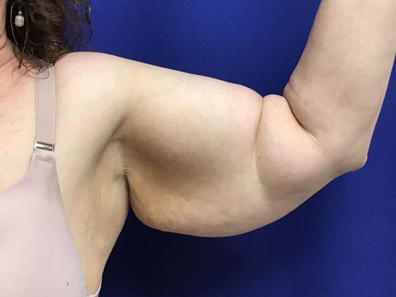 Arm Contouring / Lift: Case 8  (2905148) - Before, left arm, front view