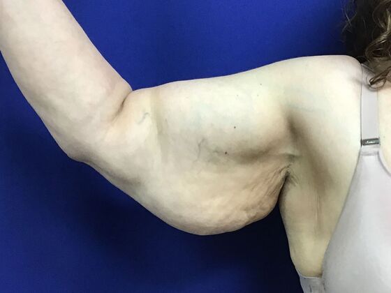 Arm Contouring / Lift: Case 8  (2905148) - Before, right arm, front view