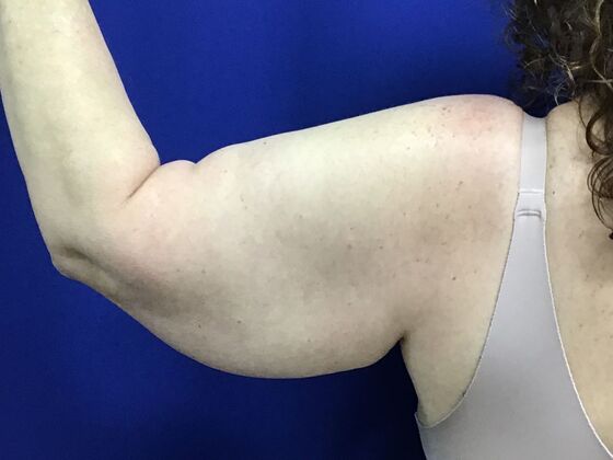 Arm Contouring / Lift Case 8  (2905148) - Before