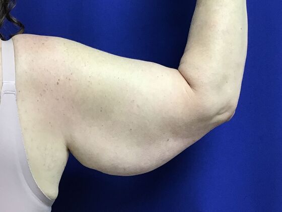 Arm Contouring / Lift: Case 8  (2905148) - Before, right arm, viewed from the back