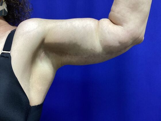Arm Contouring / Lift: Case 8  (2905148) - After, left arm, front view
