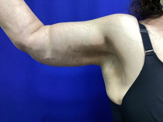 Arm Contouring / Lift: Case 8  (2905148) - After, right arm, front view