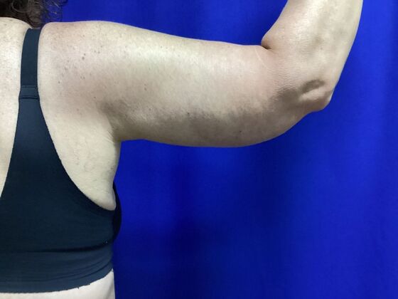 Arm Contouring / Lift: Case 8  (2905148) - After, right arm, viewed fron the back