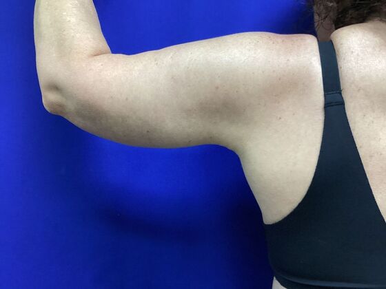 Arm Contouring / Lift Case 8  (2905148) - After