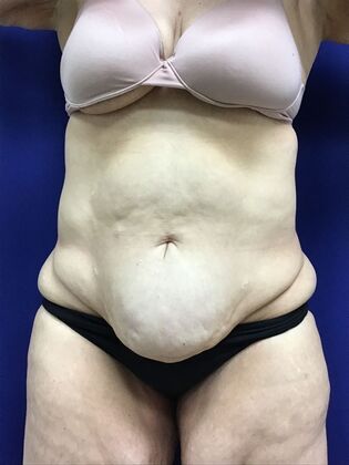 Body Tummy Tuck / Abdominoplasty Case 25 (2905148) - Before