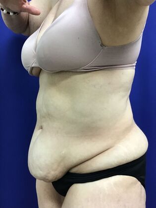 Body Tummy Tuck / Abdominoplasty: Case 25 (2905148) - Before