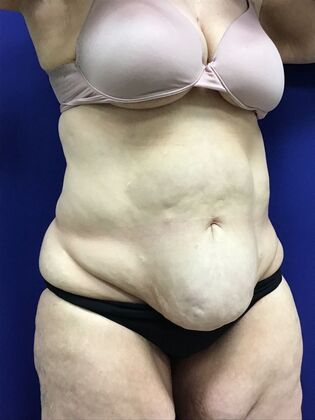 Body Tummy Tuck / Abdominoplasty: Case 25 (2905148) - Before