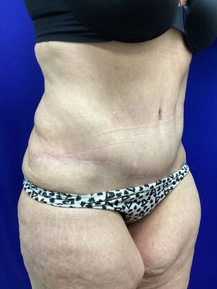 Body Tummy Tuck / Abdominoplasty: Case 25 (2905148) - After