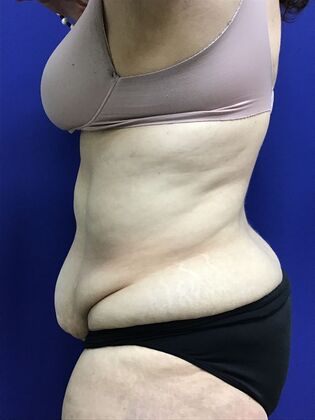 Body Tummy Tuck / Abdominoplasty: Case 25 (2905148) - Before